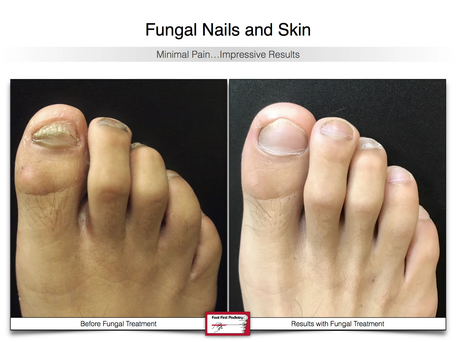 Fungal Nails — Foot First Podiatry Centers